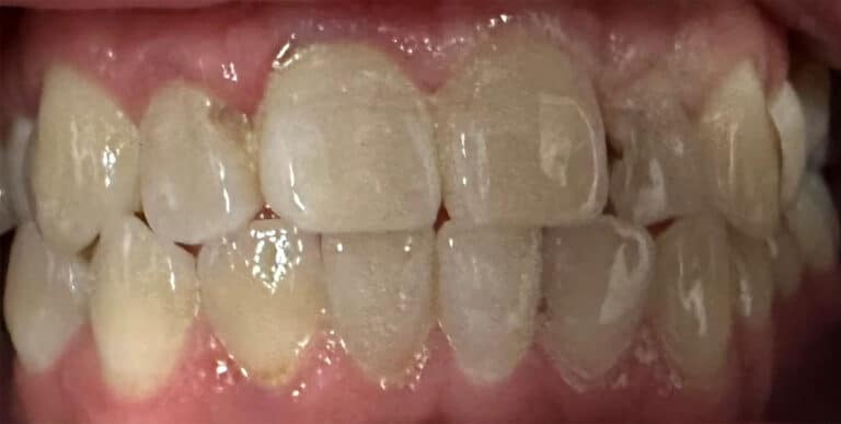Before Image: Crowns, Composites and Zoom Whitening - front
