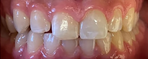 After Image: Single Crown - 