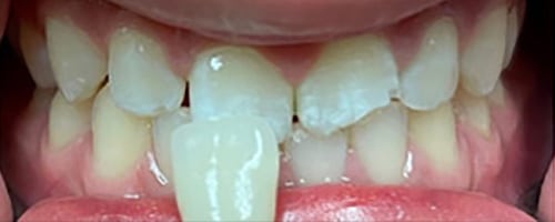 Before Image: Single Crown - 