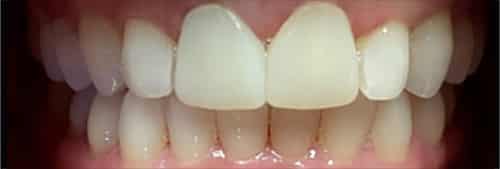 After Image: Veneer and Crown - front