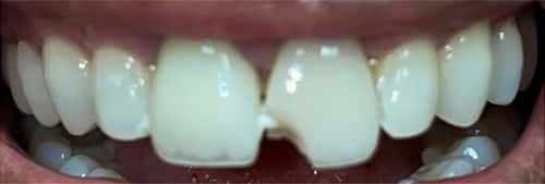 Before Image: Veneer and Crown - front