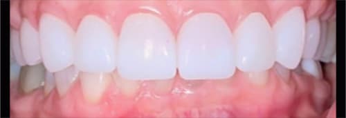 After Image: Upper Veneers and Crowns - front