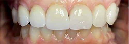 Before Image: Upper Veneers and Crowns - front