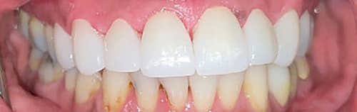 After Image: Upper Crowns and Veneers - front