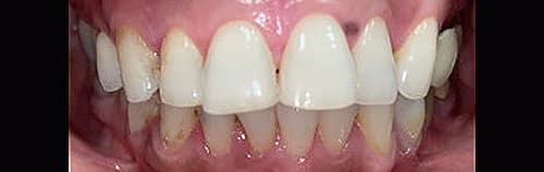Before Image: Upper Crowns and Veneers - front