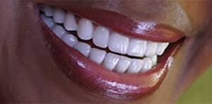 After Image: Full Mouth Reconstruction