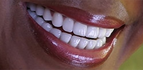 After Image: Full Mouth Reconstruction - right-front-oblique