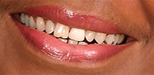 Before Image: Full Mouth Reconstruction - right-front-oblique