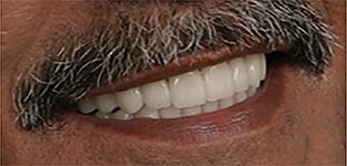 After Image: Full Mouth Reconstruction - right-front-oblique