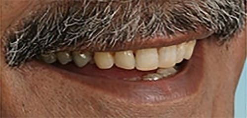 Before Image: Full Mouth Reconstruction - right-front-oblique