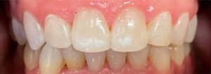 After Image: Invisalign