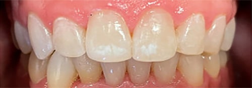 After Image: Invisalign - front