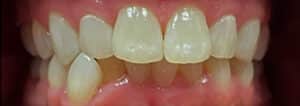 Before Image: Invisalign