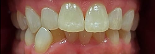 Before Image: Invisalign - front