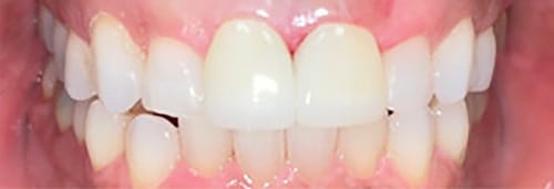 After Image: Invisalign + 2 Veneers - front