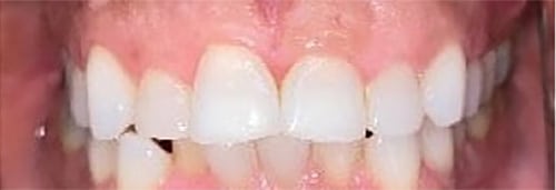 Before Image: Invisalign + 2 Veneers - front