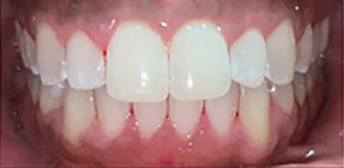 After Image: Invisalign - front