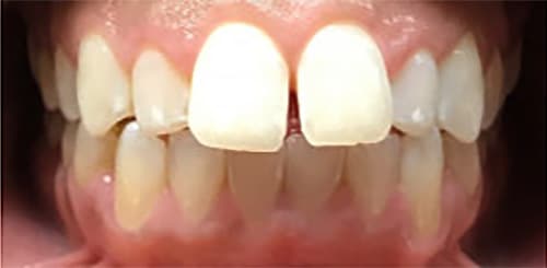 Before Image: Invisalign - front