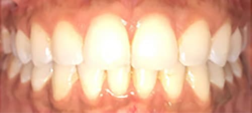After Image: Invisalign - front