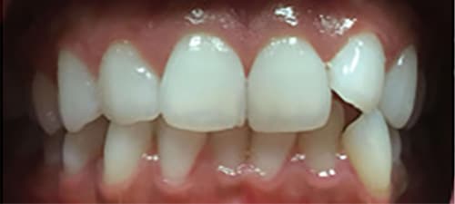 Before Image: Invisalign - front