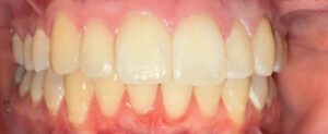 After Image: Invisalign