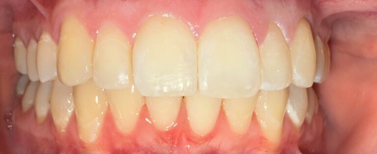After Image: Invisalign - front