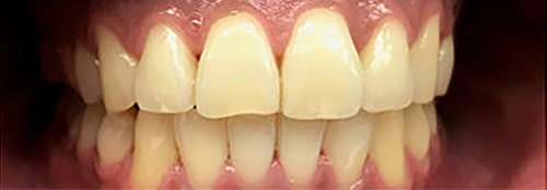 After Image: Orthodontics - front