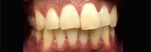 Before Image: Orthodontics - front