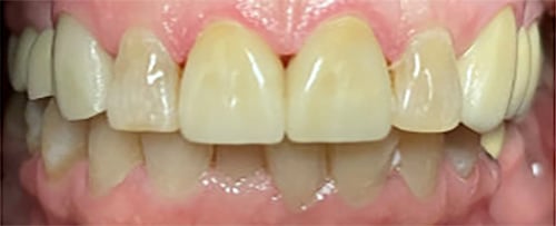 After Image: 2 Front Veneers - front