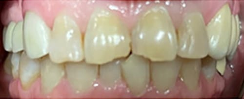 Before Image: 2 Front Veneers - front