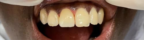 After Image: Veneer - front