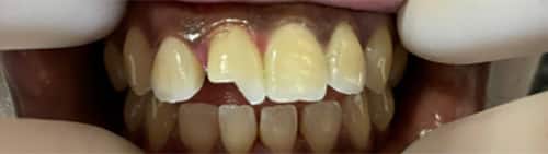 Before Image: Veneer - front