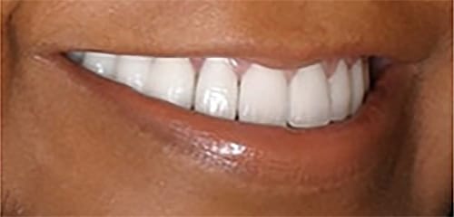 After Image: Veneers - right-front-oblique