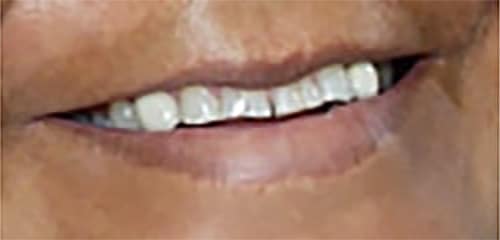 Before Image: Veneers - right-front-oblique