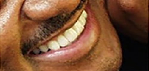 After Image: Veneers - other