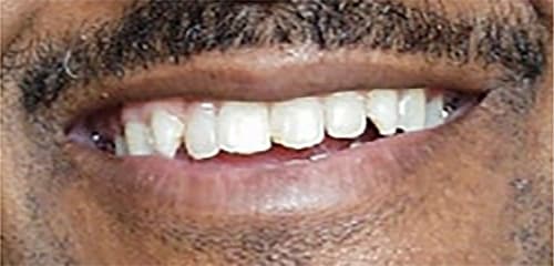Before Image: Veneers - other