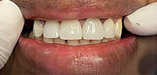After Image: Veneers - front