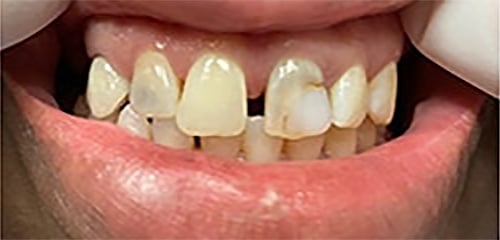 Before Image: Veneers - front