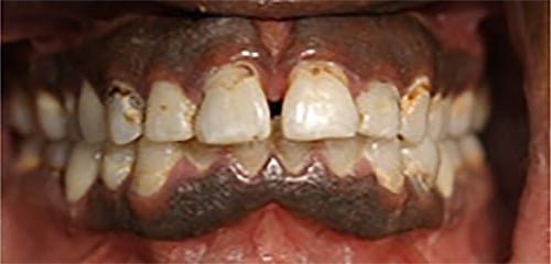 Before Image: Veneers - front