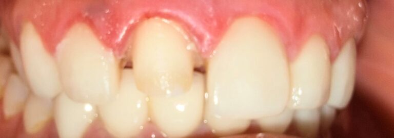 Before Image: Veneer - front