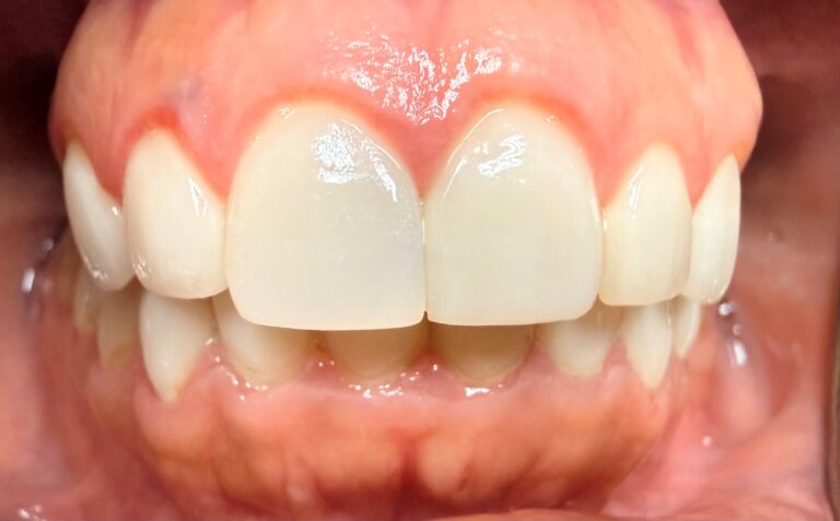 After Image: Veneer - front