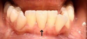 After Image: 1 Front Lower Veneer