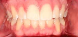 After Image: Invisalign