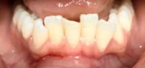 Before Image: 1 Front Lower Veneer