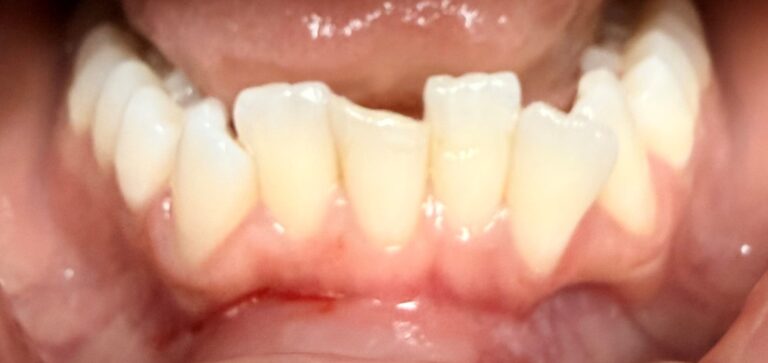 Before Image: 1 Front Lower Veneer - front