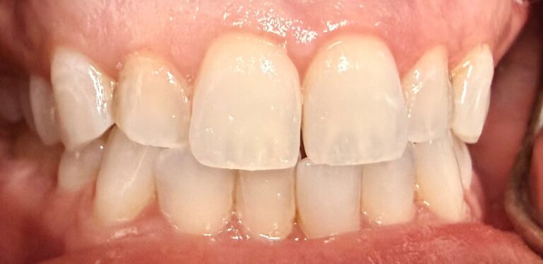 Before Image: 2 Veneers - front