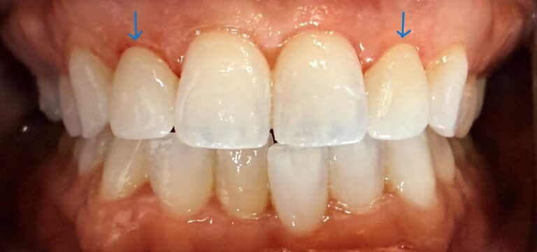 After Image: 2 Veneers - front