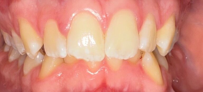 Before Image: Invisalign - front