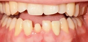 Before Image: Veneer