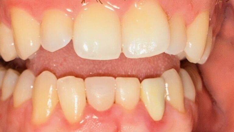 After Image: Veneer - front